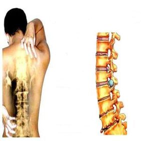Mpaghara osteochondrosis