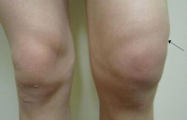 Mesinical ngosipụta nke akpịrị na nkwonkwo ikpere