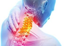 Ihe mgbaàmà nke osteochondrosis na ihe oriri na-edozi ahụ maka ọrịa