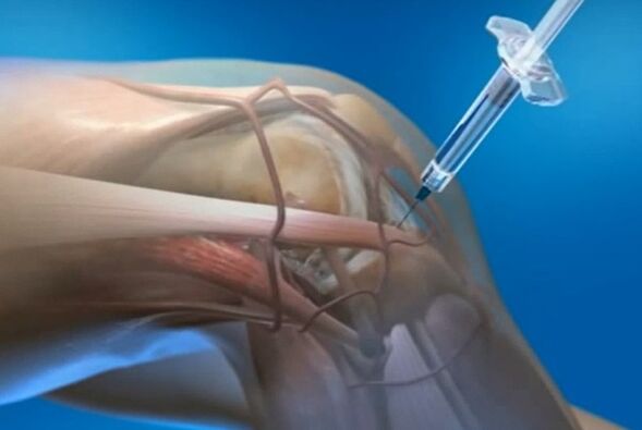 interration intermerticular maka arthrosis nke nkwonkwo ikpere