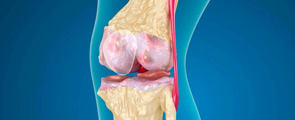 arthrosis nke nkwonkwo ikpere