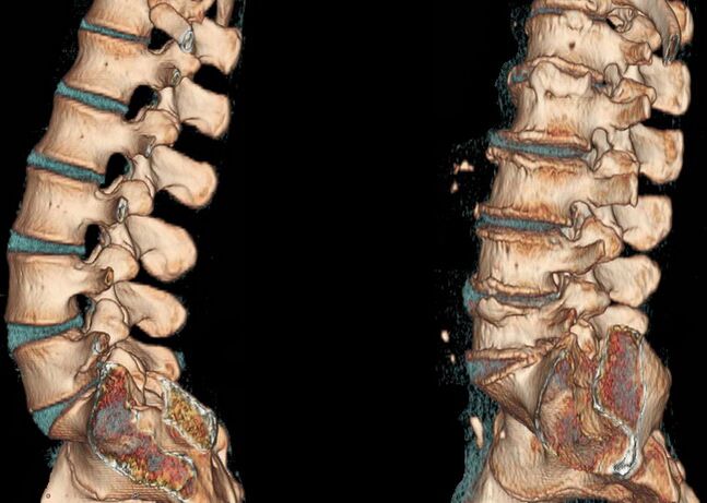 Osteochondrosis nke ọkpụkpụ azụ na nyocha CT